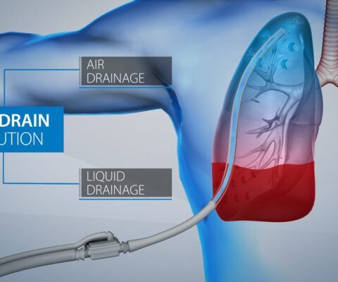 Round Coaxial Thoracic Drain (One Drain Solution) by Redax